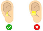 schéme de positionnement des bouchons d'oreille jetables